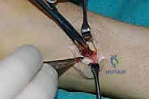 موقع وتر الظنبوب الخلفي