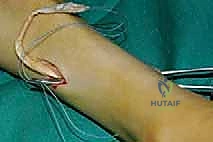 تشريح الأوتار في الكاحل