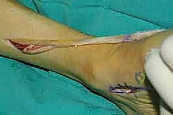 الأعصاب المغذية للطرف السفلي