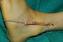 التخطيط الجراحي لنقل الوتر