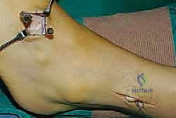 تشوهات القدم الناتجة عن إهمال العلاج