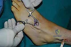 صورة طبية: نقل وتر الظنبوب الخلفي الديناميكي لعلاج تدلي القدم: استعادة الحركة والحياة الطبيعية مع الأستاذ الدكتور محمد هطيف