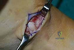 مقارنة بين العلاج التحفظي والجراحي