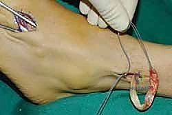 صورة توضيحية لـ نقل وتر الظنبوب الخلفي الديناميكي لعلاج تدلي القدم: استعادة الحركة والحياة الطبيعية مع الأستاذ الدكتور محمد هطيف