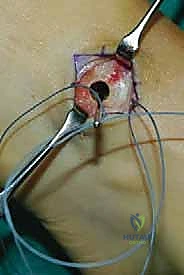 صورة طبية: نقل وتر الظنبوب الخلفي الديناميكي لعلاج تدلي القدم: استعادة الحركة والحياة الطبيعية مع الأستاذ الدكتور محمد هطيف