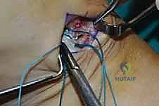 صعوبة صعود السلالم بسبب تدلي القدم