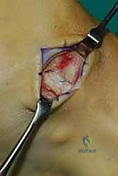 الضغط على جذور الأعصاب في العمود الفقري