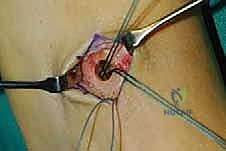 صورة طبية: نقل وتر الظنبوب الخلفي الديناميكي لعلاج تدلي القدم: استعادة الحركة والحياة الطبيعية مع الأستاذ الدكتور محمد هطيف