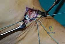 صورة طبية: نقل وتر الظنبوب الخلفي الديناميكي لعلاج تدلي القدم: استعادة الحركة والحياة الطبيعية مع الأستاذ الدكتور محمد هطيف