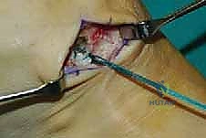 صورة طبية: نقل وتر الظنبوب الخلفي الديناميكي لعلاج تدلي القدم: استعادة الحركة والحياة الطبيعية مع الأستاذ الدكتور محمد هطيف