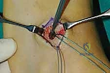 صورة طبية: نقل وتر الظنبوب الخلفي الديناميكي لعلاج تدلي القدم: استعادة الحركة والحياة الطبيعية مع الأستاذ الدكتور محمد هطيف