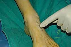 صورة طبية: نقل وتر الظنبوب الخلفي الديناميكي لعلاج تدلي القدم: استعادة الحركة والحياة الطبيعية مع الأستاذ الدكتور محمد هطيف