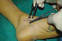 صورة طبية: نقل وتر الظنبوب الخلفي الديناميكي لعلاج تدلي القدم: استعادة الحركة والحياة الطبيعية مع الأستاذ الدكتور محمد هطيف