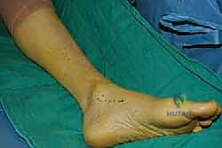 تأثير الأمراض العصبية على المشي