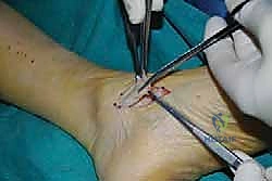 صورة طبية: نقل وتر الظنبوب الخلفي الديناميكي لعلاج تدلي القدم: استعادة الحركة والحياة الطبيعية مع الأستاذ الدكتور محمد هطيف