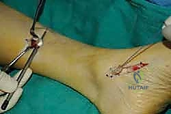 صورة طبية: نقل وتر الظنبوب الخلفي الديناميكي لعلاج تدلي القدم: استعادة الحركة والحياة الطبيعية مع الأستاذ الدكتور محمد هطيف