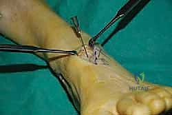 إصابة العصب الشظوي