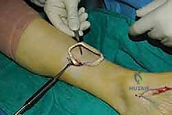 صورة طبية: نقل وتر الظنبوب الخلفي الديناميكي لعلاج تدلي القدم: استعادة الحركة والحياة الطبيعية مع الأستاذ الدكتور محمد هطيف