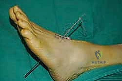 صورة طبية: نقل وتر الظنبوب الخلفي الديناميكي لعلاج تدلي القدم: استعادة الحركة والحياة الطبيعية مع الأستاذ الدكتور محمد هطيف