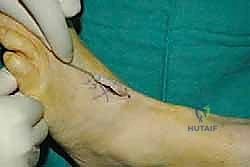 صورة توضيحية لـ نقل وتر الظنبوب الخلفي الديناميكي لعلاج تدلي القدم: استعادة الحركة والحياة الطبيعية مع الأستاذ الدكتور محمد هطيف