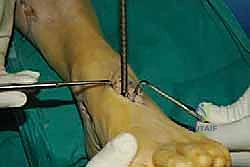 صورة طبية: نقل وتر الظنبوب الخلفي الديناميكي لعلاج تدلي القدم: استعادة الحركة والحياة الطبيعية مع الأستاذ الدكتور محمد هطيف