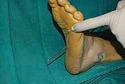 صورة طبية: نقل وتر الظنبوب الخلفي الديناميكي لعلاج تدلي القدم: استعادة الحركة والحياة الطبيعية مع الأستاذ الدكتور محمد هطيف