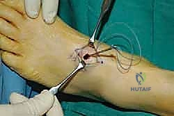 أشعة سينية للكاحل