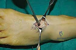 صورة طبية: نقل وتر الظنبوب الخلفي الديناميكي لعلاج تدلي القدم: استعادة الحركة والحياة الطبيعية مع الأستاذ الدكتور محمد هطيف