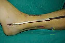 صورة توضيحية لـ نقل وتر الظنبوب الخلفي الديناميكي لعلاج تدلي القدم: استعادة الحركة والحياة الطبيعية مع الأستاذ الدكتور محمد هطيف