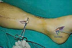 صورة طبية: نقل وتر الظنبوب الخلفي الديناميكي لعلاج تدلي القدم: استعادة الحركة والحياة الطبيعية مع الأستاذ الدكتور محمد هطيف