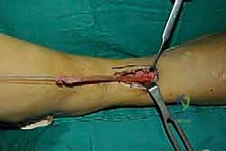 شقوق الجراحة وحصاد الوتر