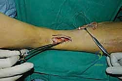 صورة طبية: نقل وتر الظنبوب الخلفي الديناميكي لعلاج تدلي القدم: استعادة الحركة والحياة الطبيعية مع الأستاذ الدكتور محمد هطيف