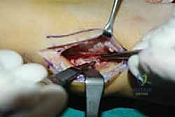 تمرير الوتر إلى الجزء الأمامي