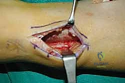 صورة توضيحية لـ نقل وتر الظنبوب الخلفي الديناميكي لعلاج تدلي القدم: استعادة الحركة والحياة الطبيعية مع الأستاذ الدكتور محمد هطيف