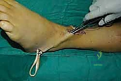 تقنية Bridle Procedure لتوازن القدم