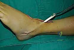 صورة طبية: نقل وتر الظنبوب الخلفي الديناميكي لعلاج تدلي القدم: استعادة الحركة والحياة الطبيعية مع الأستاذ الدكتور محمد هطيف