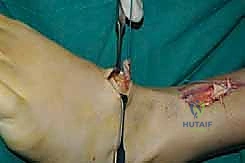 تثبيت الوتر في عظام القدم