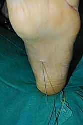 صورة طبية: نقل وتر الظنبوب الخلفي الديناميكي لعلاج تدلي القدم: استعادة الحركة والحياة الطبيعية مع الأستاذ الدكتور محمد هطيف