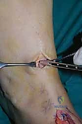 Illustration of common peroneal nerve - Dr. Mohammed Hutaif