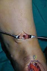 صورة توضيحية لـ نقل وتر الظنبوب الخلفي الديناميكي لعلاج تدلي القدم: استعادة الحركة والحياة الطبيعية مع الأستاذ الدكتور محمد هطيف