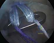Arthroscopic AC Joint Reduction and Coracoclavicular Stabilization: A TightRope Masterclass
