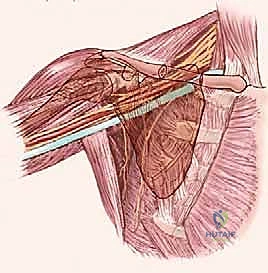 صورة توضيحية لـ استئصال أورام الإبط المعقدة: دليل شامل للمرضى مع الأستاذ الدكتور محمد هطيف