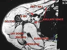 صورة توضيحية لـ استئصال أورام الإبط المعقدة: دليل شامل للمرضى مع الأستاذ الدكتور محمد هطيف