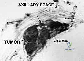 التخطيط للتدخل الجراحي