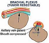 تخطيط جراحي دقيق قبل استئصال الورم
