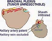 فصل الأوعية الدموية عن الورم
