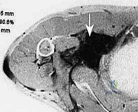 استخدام التصوير الطبي لتشخيص الورم