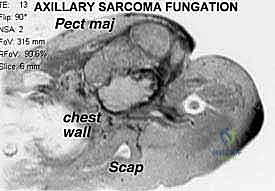 Mastering Axillary Space Resections: An Intraoperative Guide to Complex Tumor Excision and Neurovascular Preservation