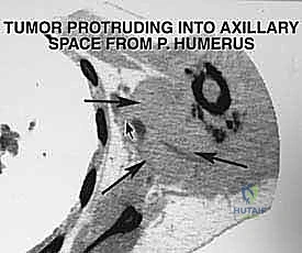 تجهيز المريض وتحديد مسار الشق الجراحي