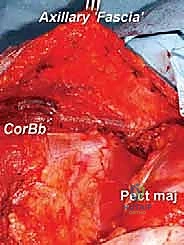 الدكتور محمد هطيف أثناء إجراء جراحة دقيقة